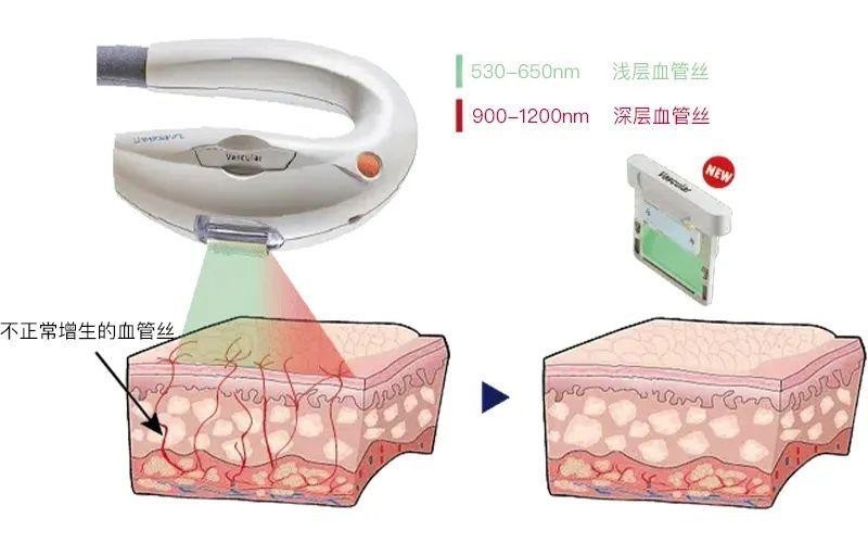 超光子中的血管濾光片作用皮膚